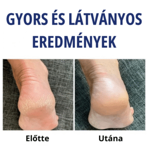 Teljes lábápoló csomag – HeelRecover - Image 5